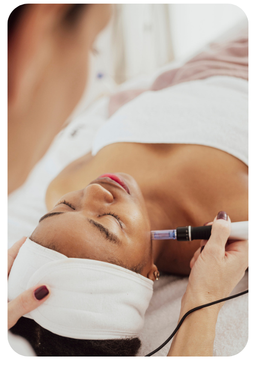 micro needling-2